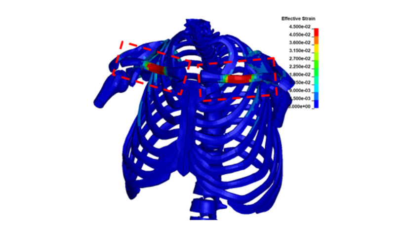 Simulation of clavicles high strain due to belt retractor action